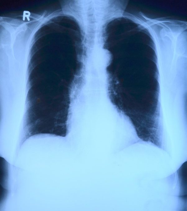 Symptoms and therapy of pulmonary fibrosis
